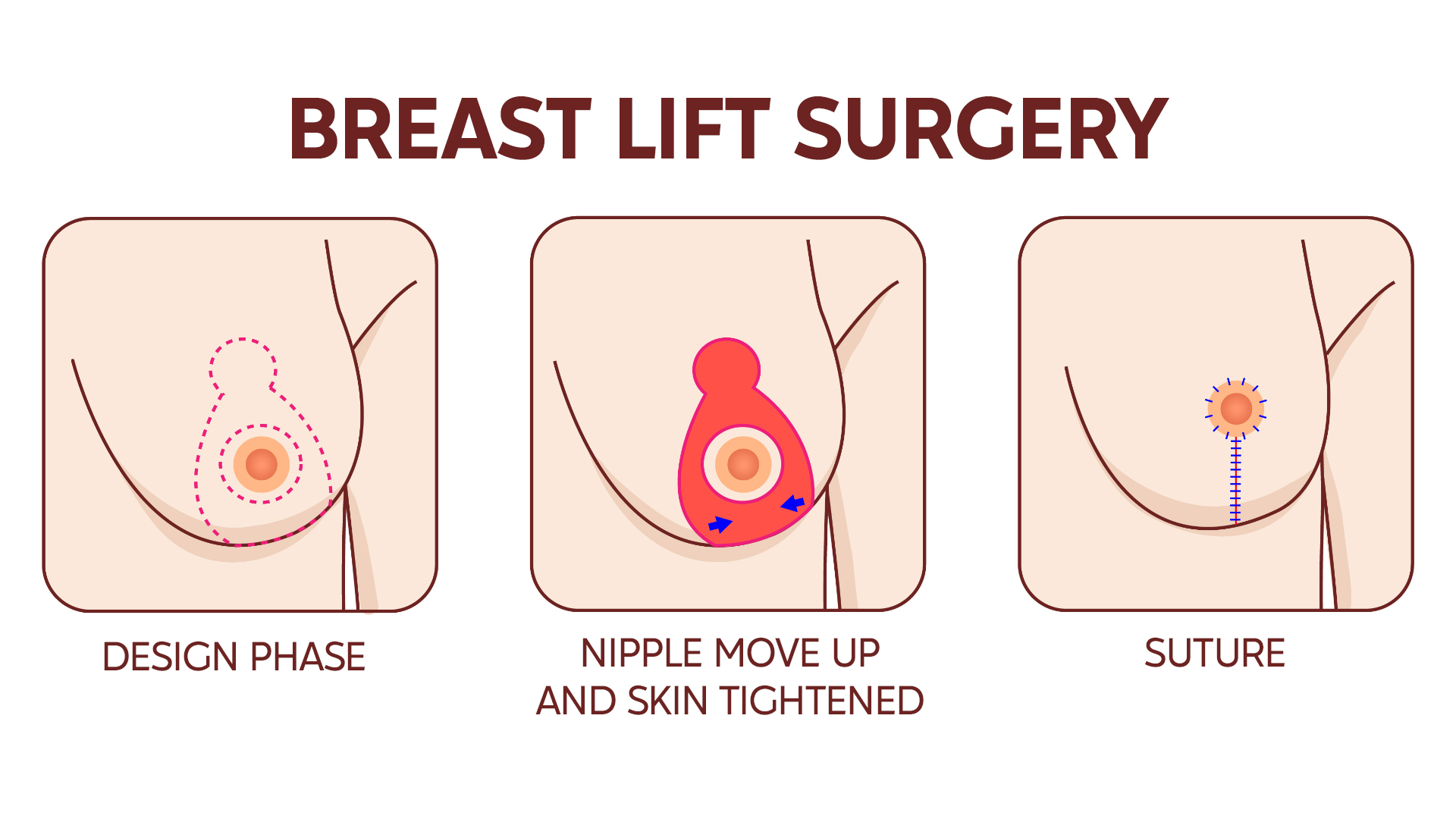 Mastopexy: everything you need to know about breast lift in Turkey