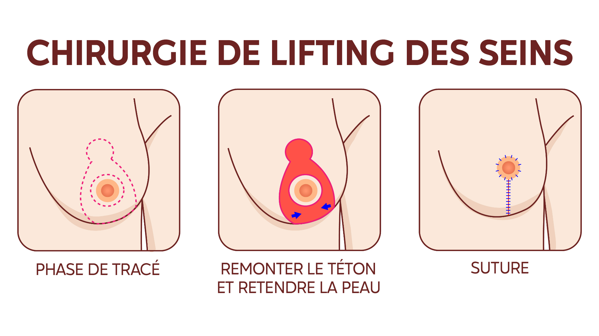 Les étapes d’une mastopexie, ou lifting du sein.