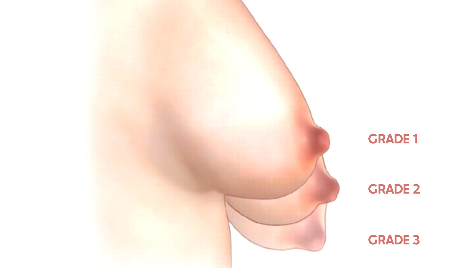 breast ptosis grades