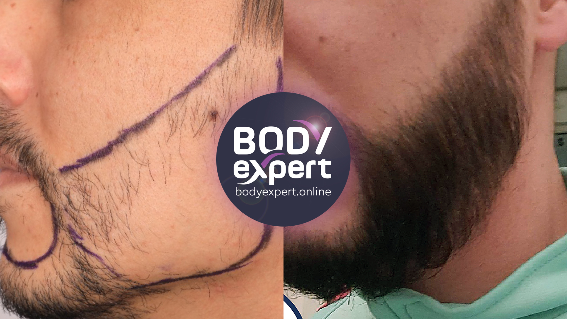 Beard transplant in Turkey : the results after 3500 grafts and 13 months