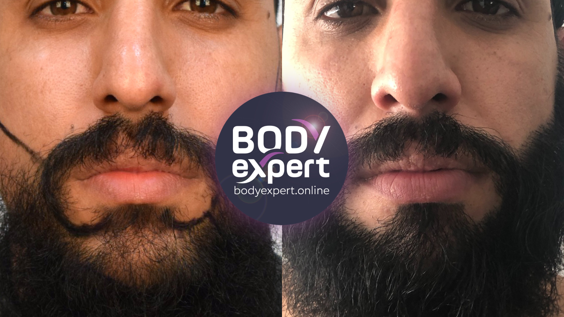 Beard Transplant : results after 3300 grafts and 7 months