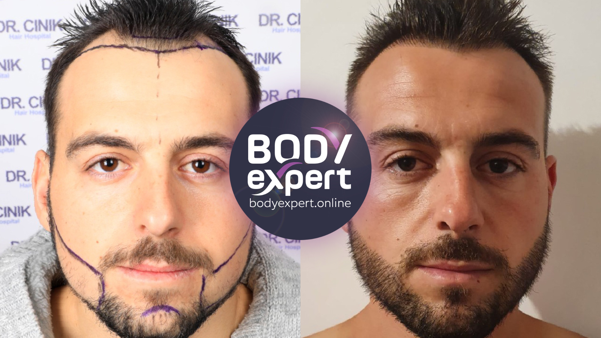 1600 grafts Beard transplant + 2000 grafts Hair transplant. Result after 1 year