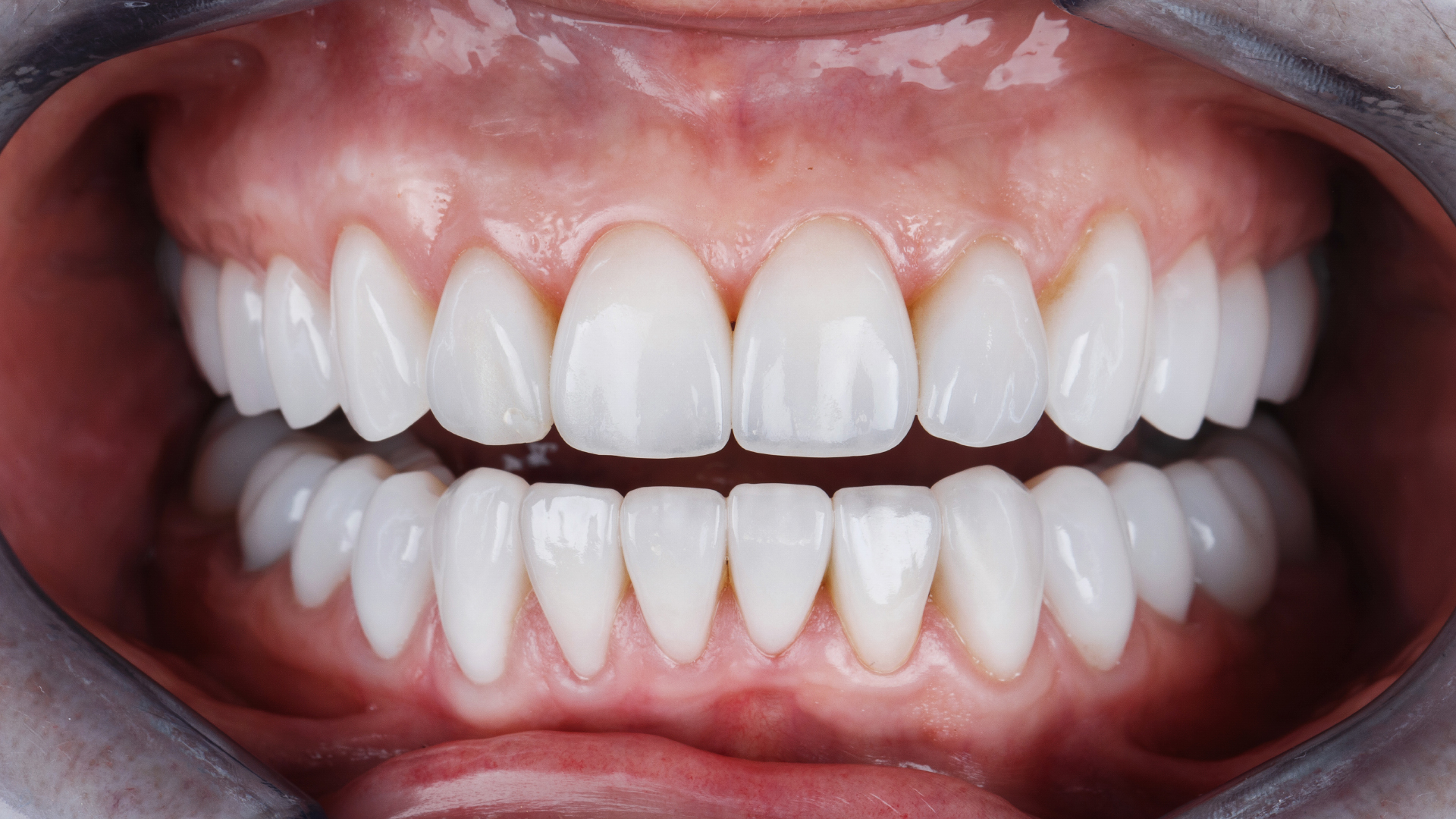 a patient who recently have porcelain veneers