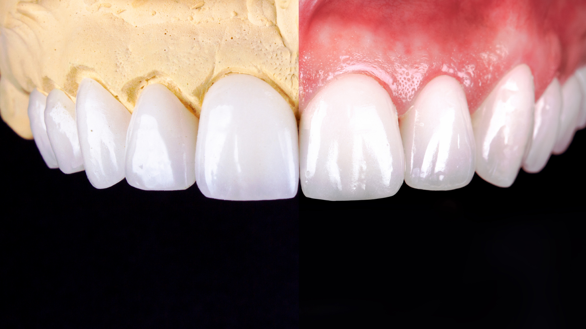 What Are The Differences Between Composite Resin Bonding & Veneers?