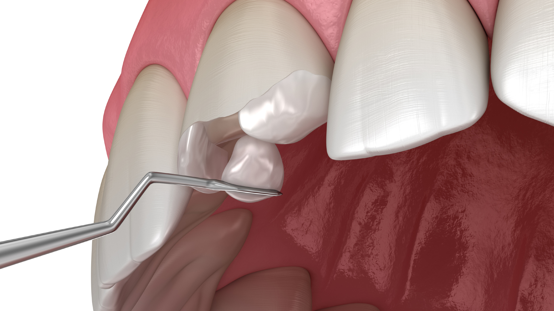 La première étape de la pose d’une facette en résine composite avec l’application d’une couche de résine