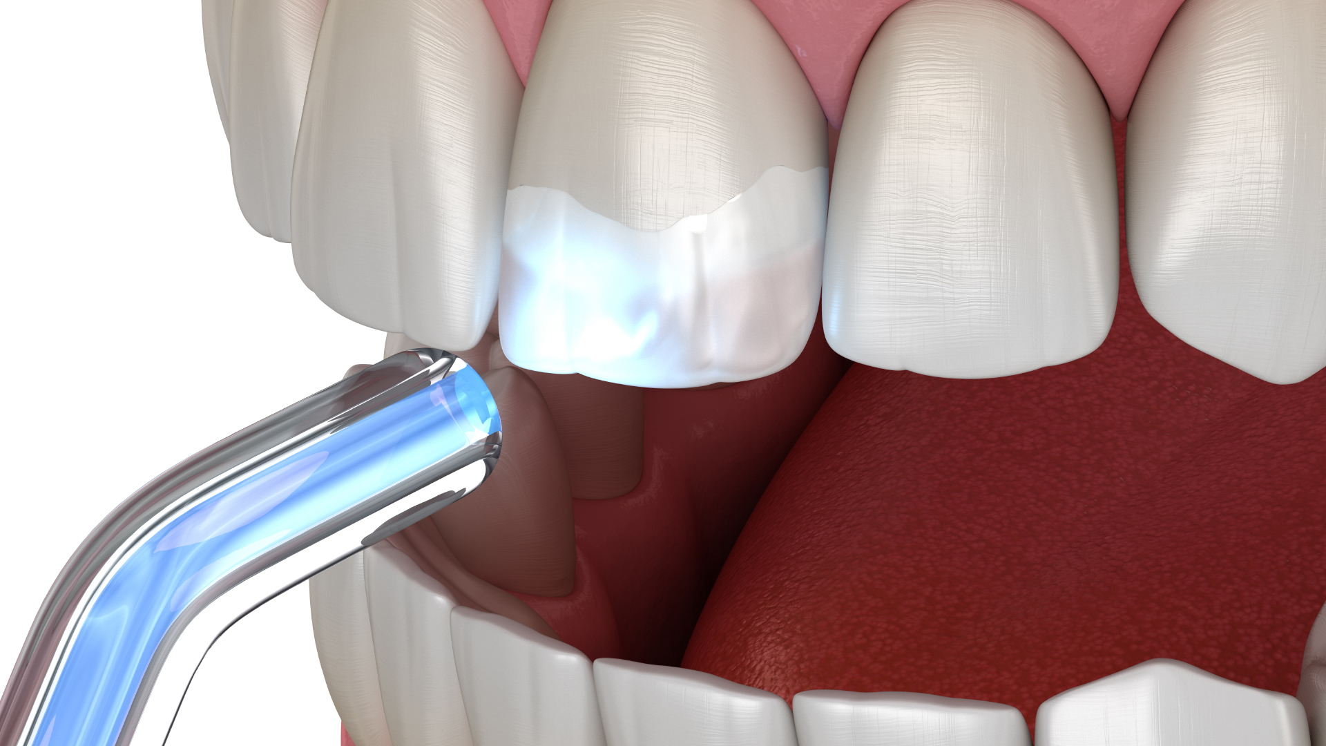 the composite resin is dried up the teeth on the direct placement technique