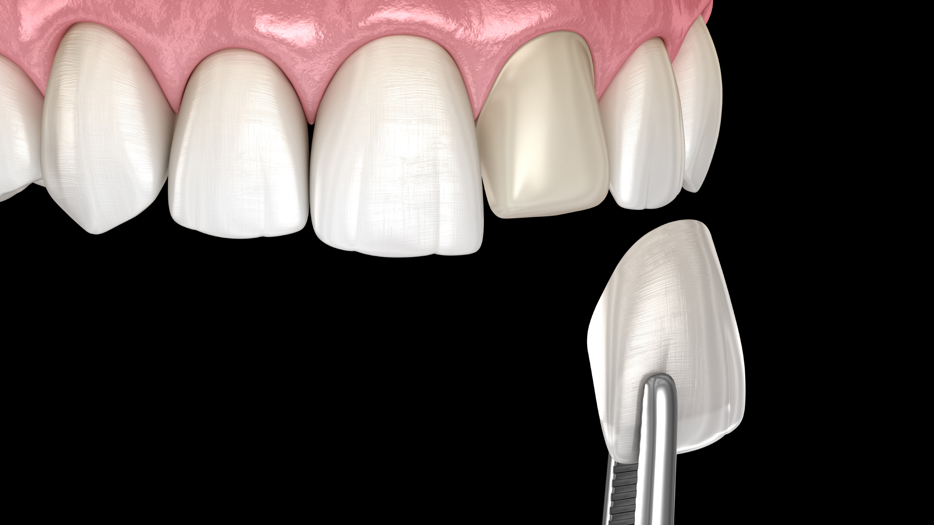 composite veneers indirect placement technique