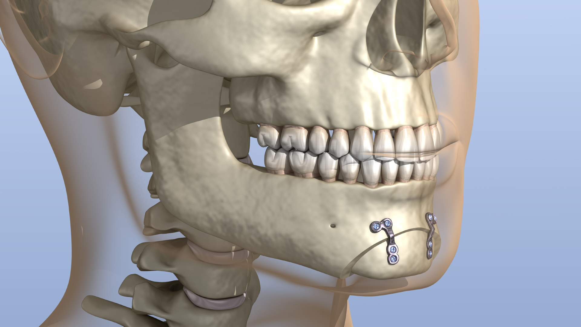 osteotomy (cut chin bone) 3D model