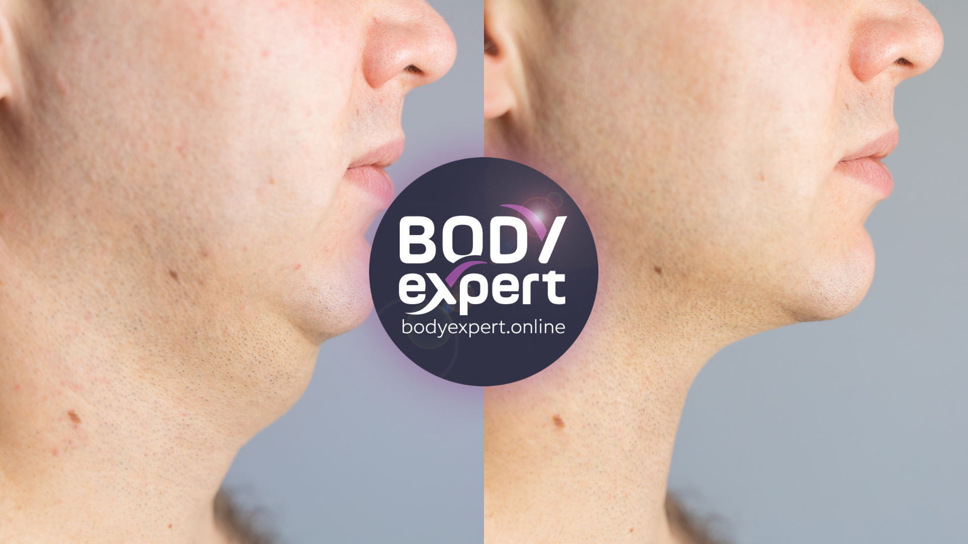 Chin liposuction in Turkey : before - after