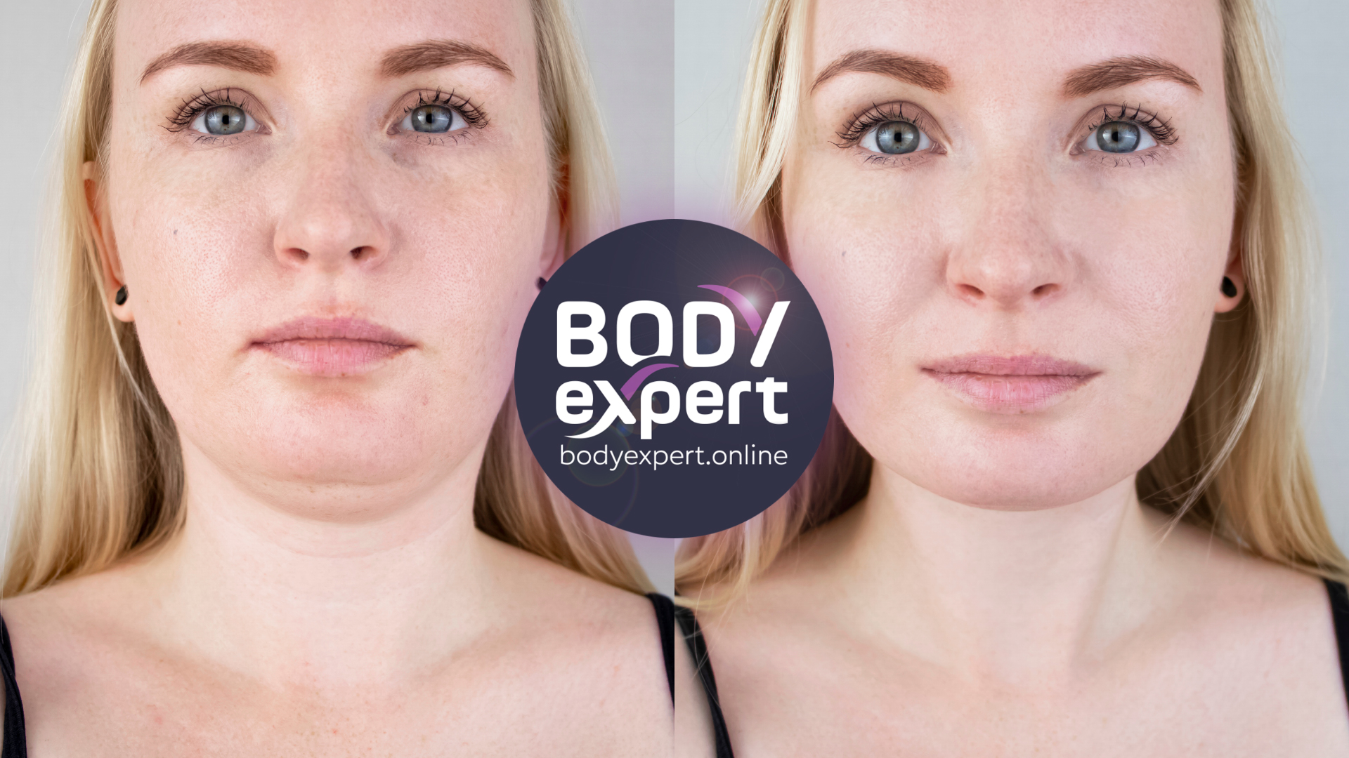 A face picture of a woman who had a double chin liposuction. On the left side before the liposuction. On the right side after the liposuction.