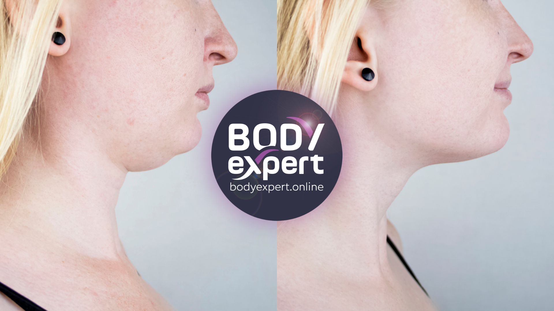 A profile picture of a woman who had a double chin liposuction. On the left side before the liposuction. On the right side after the liposuction.