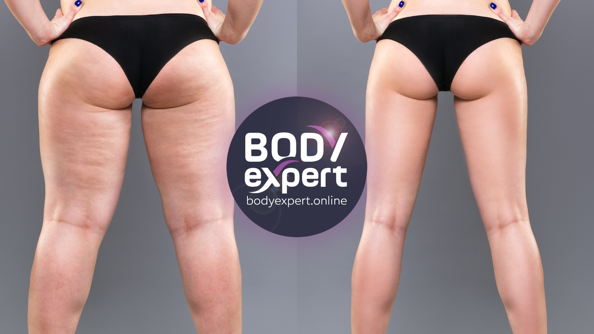 Butt and thick liposuction : before and after