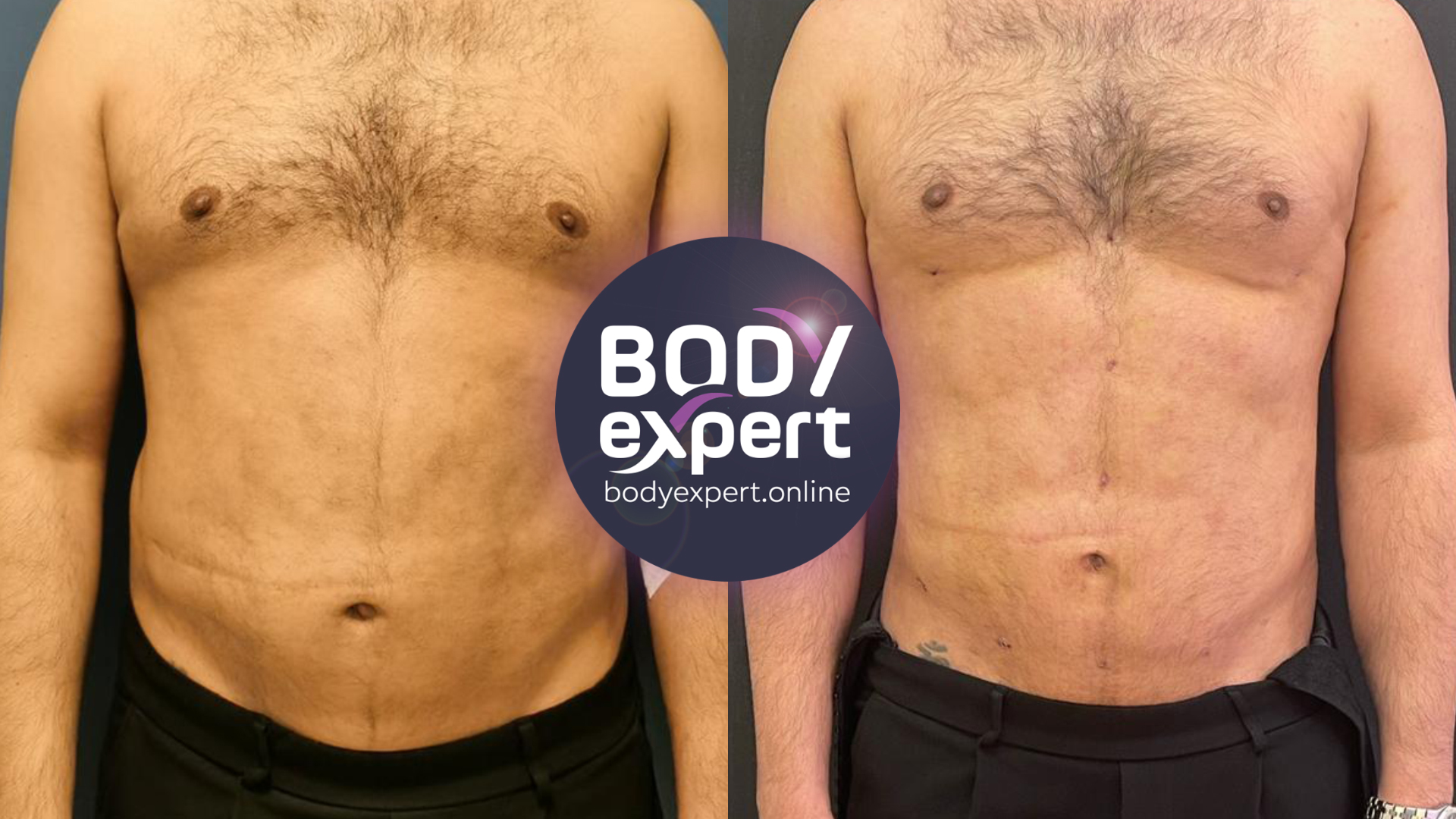Belly liposuction on men, before and after