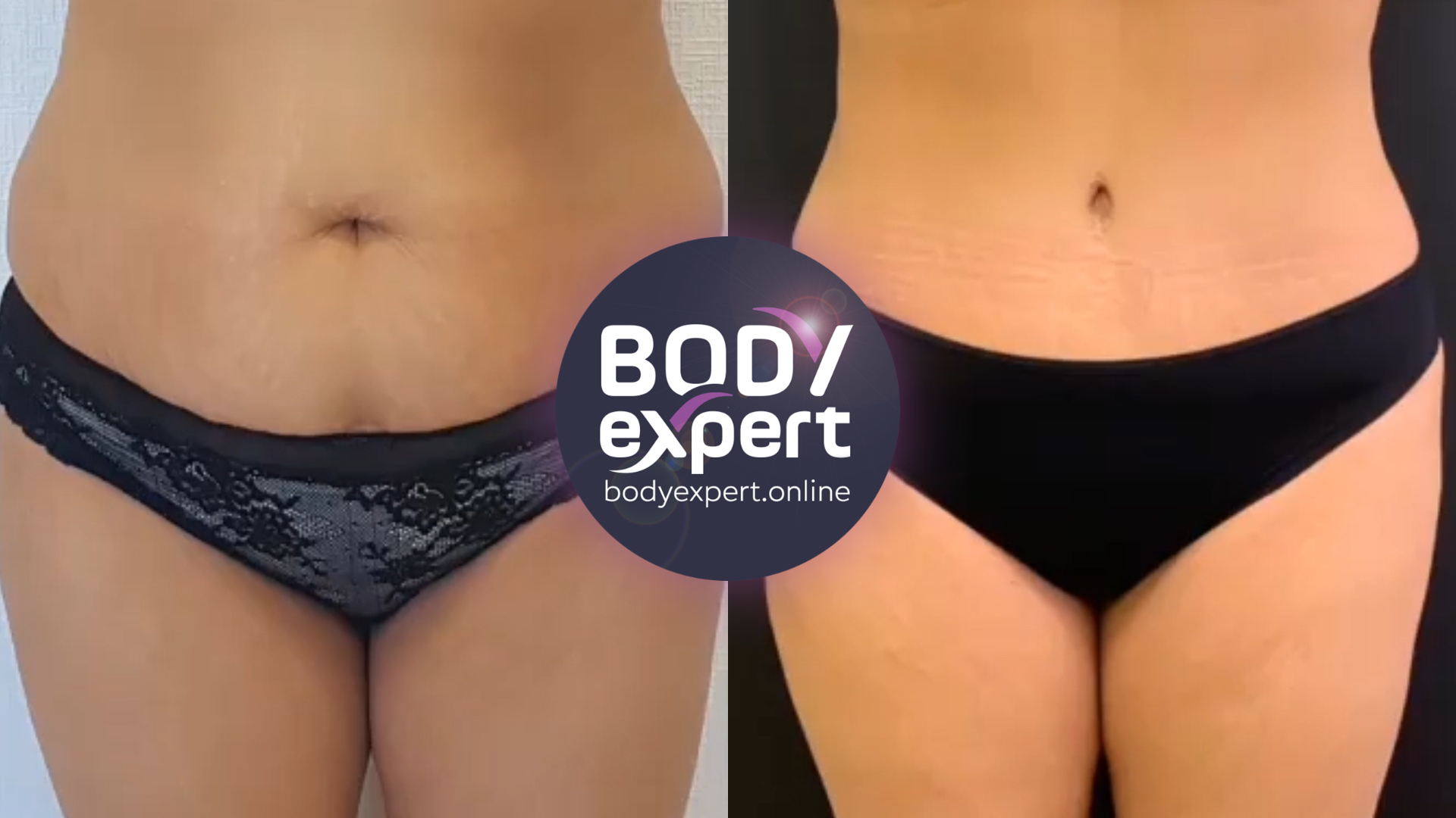 Stomach liposuction - before and after