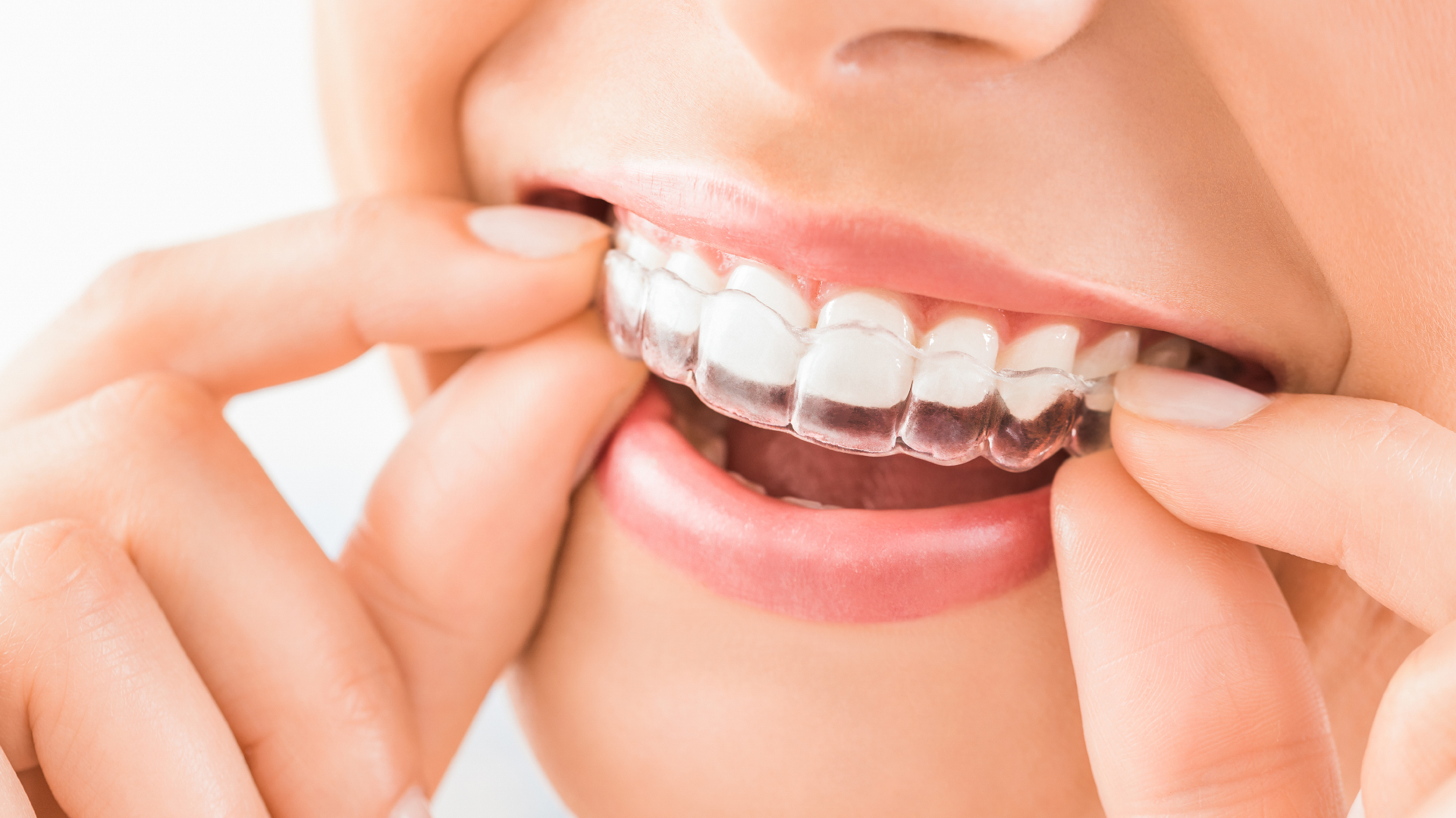 a woman placing an Invisalign on her denture