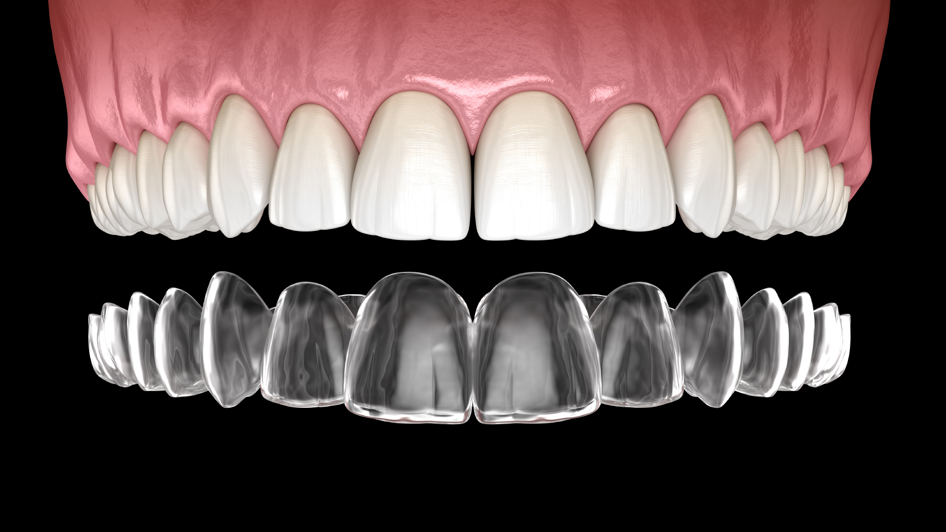 an Invisalign 3D model