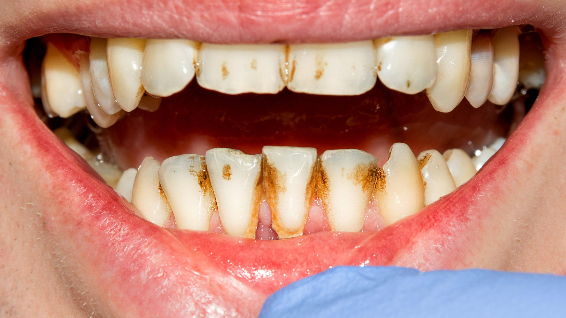 a deteriorated smile that might need veneers or crown with tooth filing