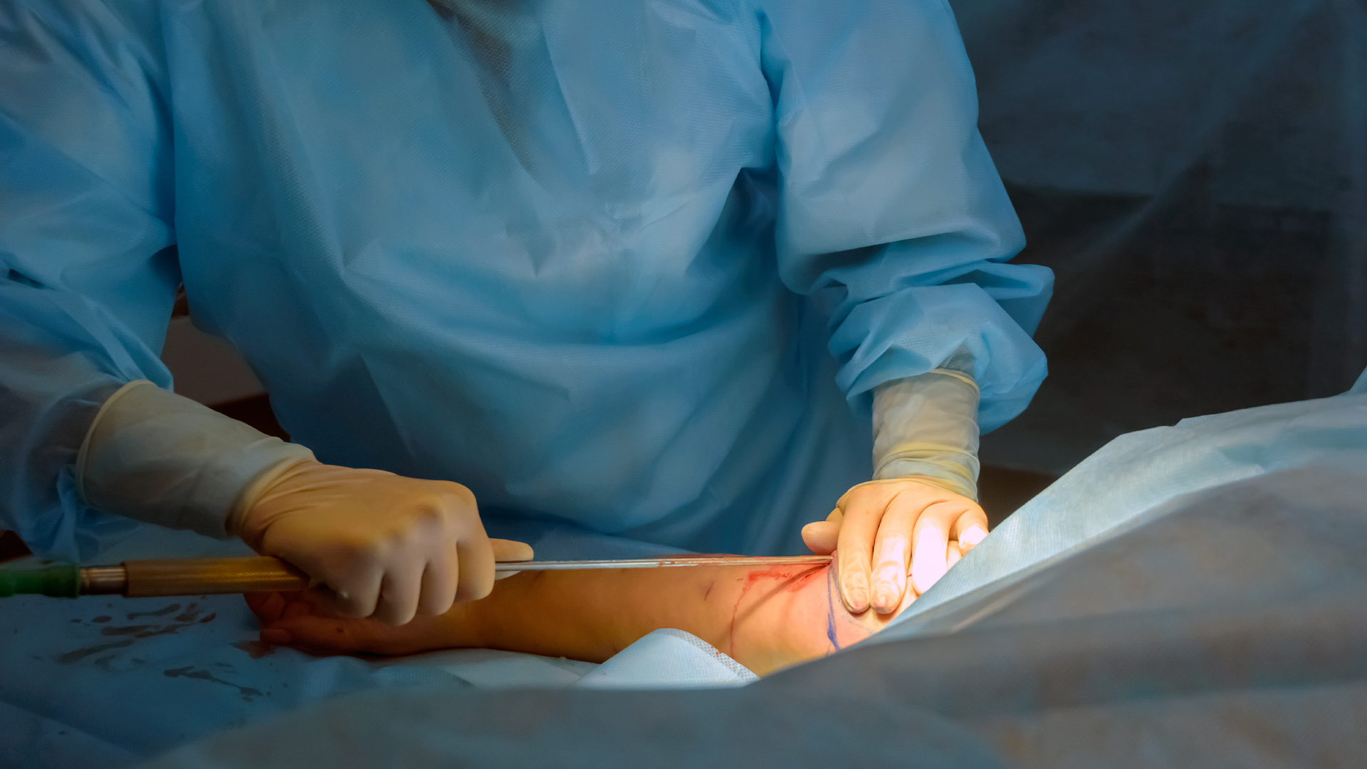 A plastic surgeon using a cannula to remove excess arm fat