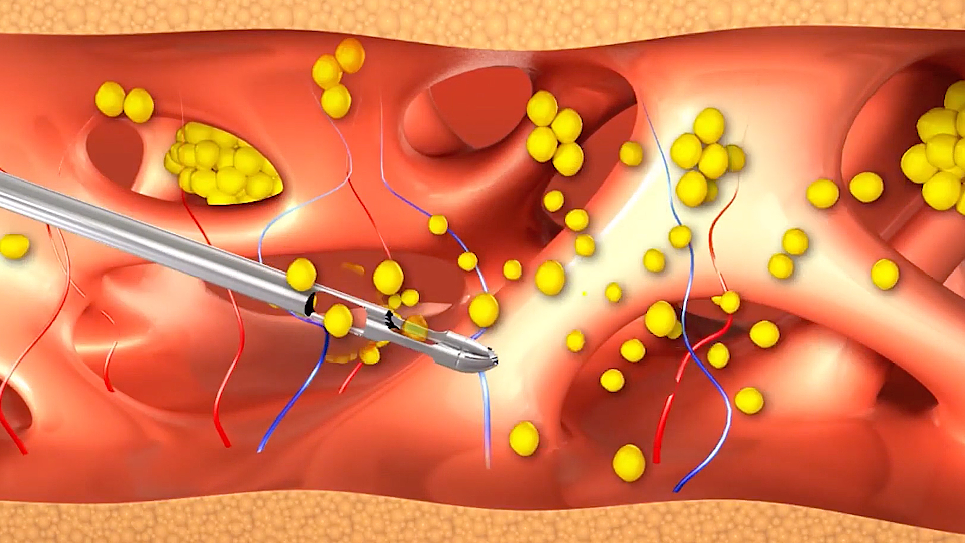 modélisation 3D d’un liposuccion des bras