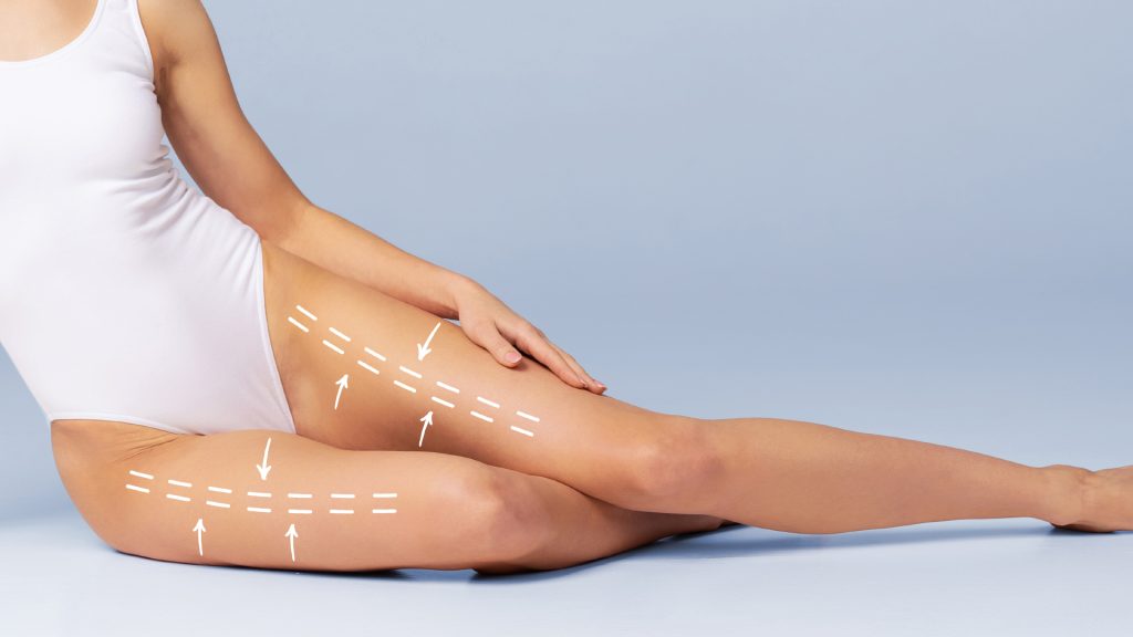 Thigh liposuction cost procedure, results before and after