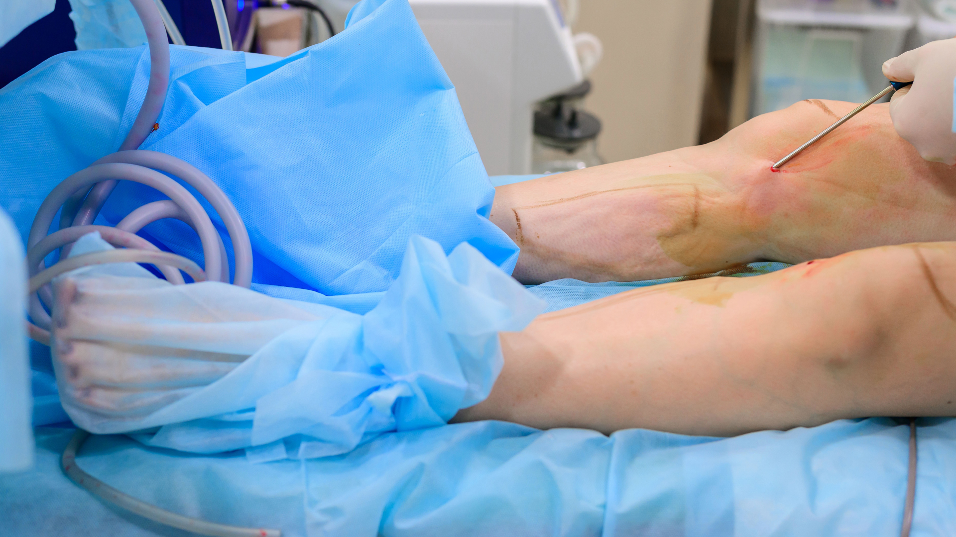 a surgeon doing a knee liposuction