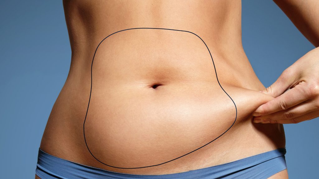 Liposuction