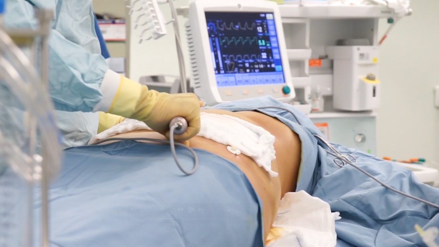 Stomach liposuction cost, procedure, results before and after