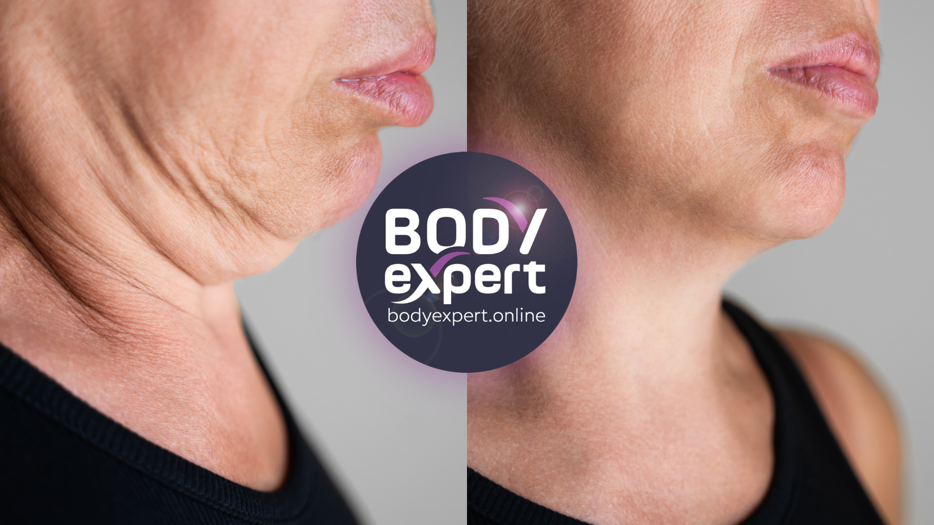 before and after neck lipo