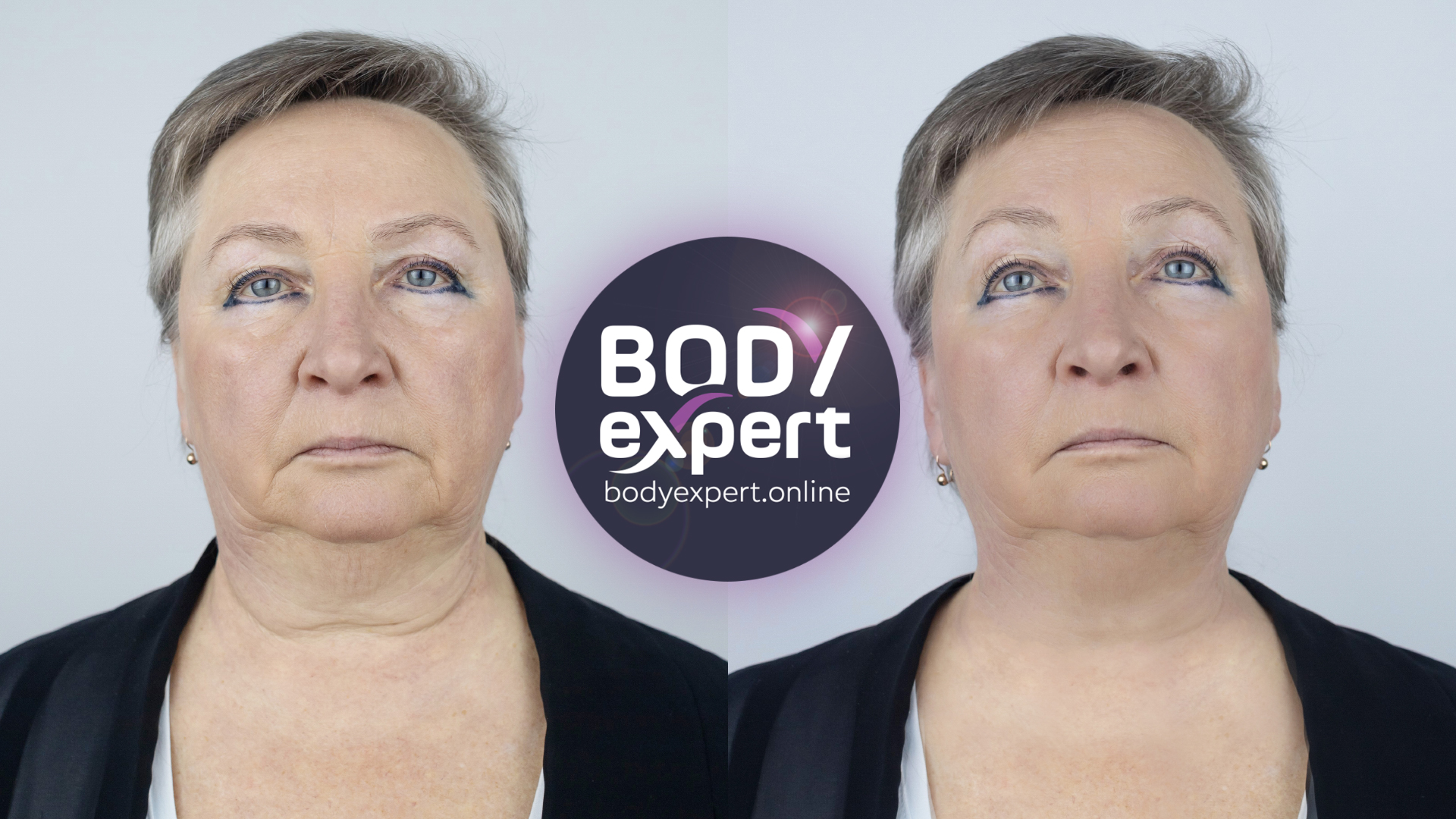 neck liposuction - before and after - face view