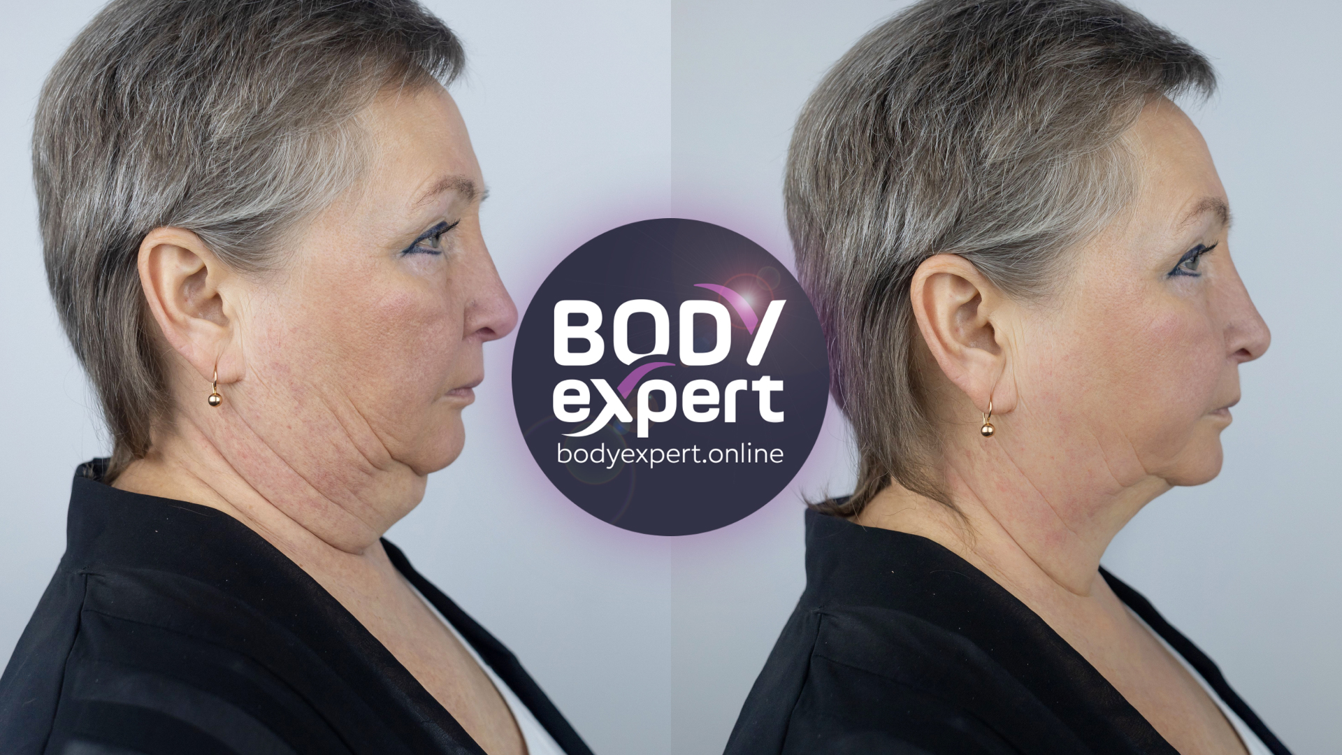 neck liposuction - before and after - profile view