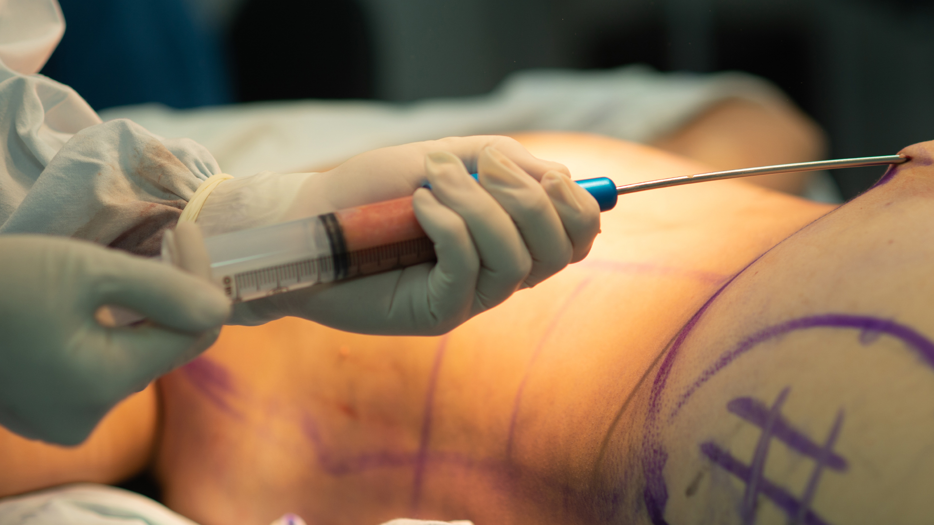 a surgeon performing hip liposuction