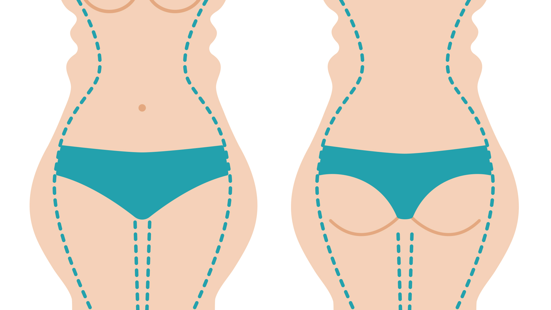 a diagram that indicates the expected benefits of liposuction