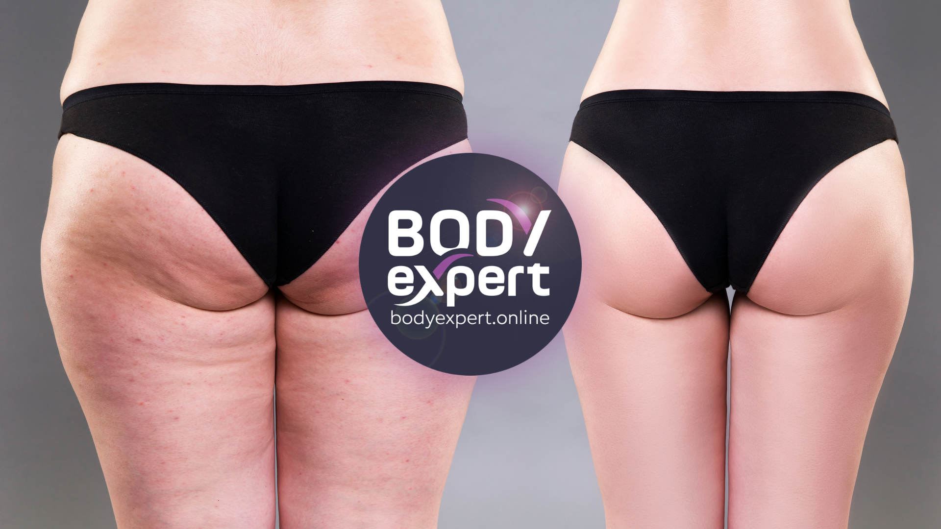 Hip lipo : before after