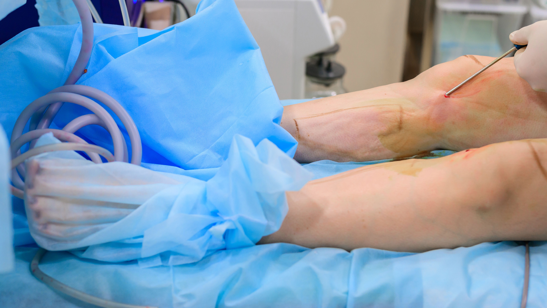 A surgeon performing calf liposuction