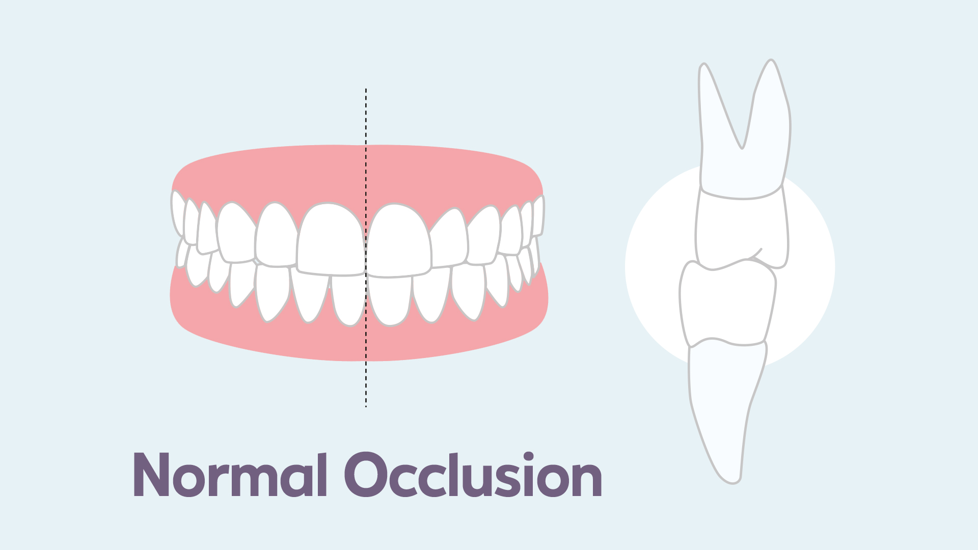 a diagram of a normal occlusion