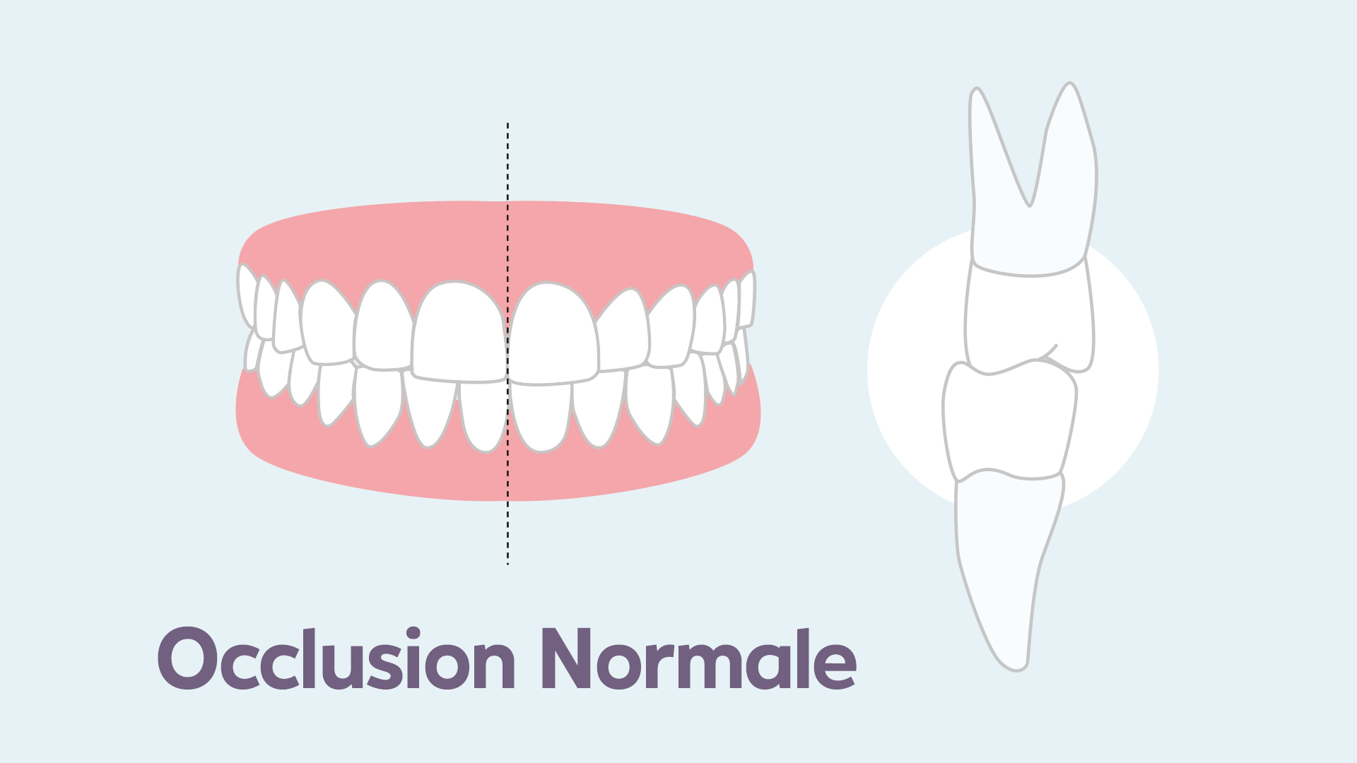 schéma d’une occlusion dentaire normale