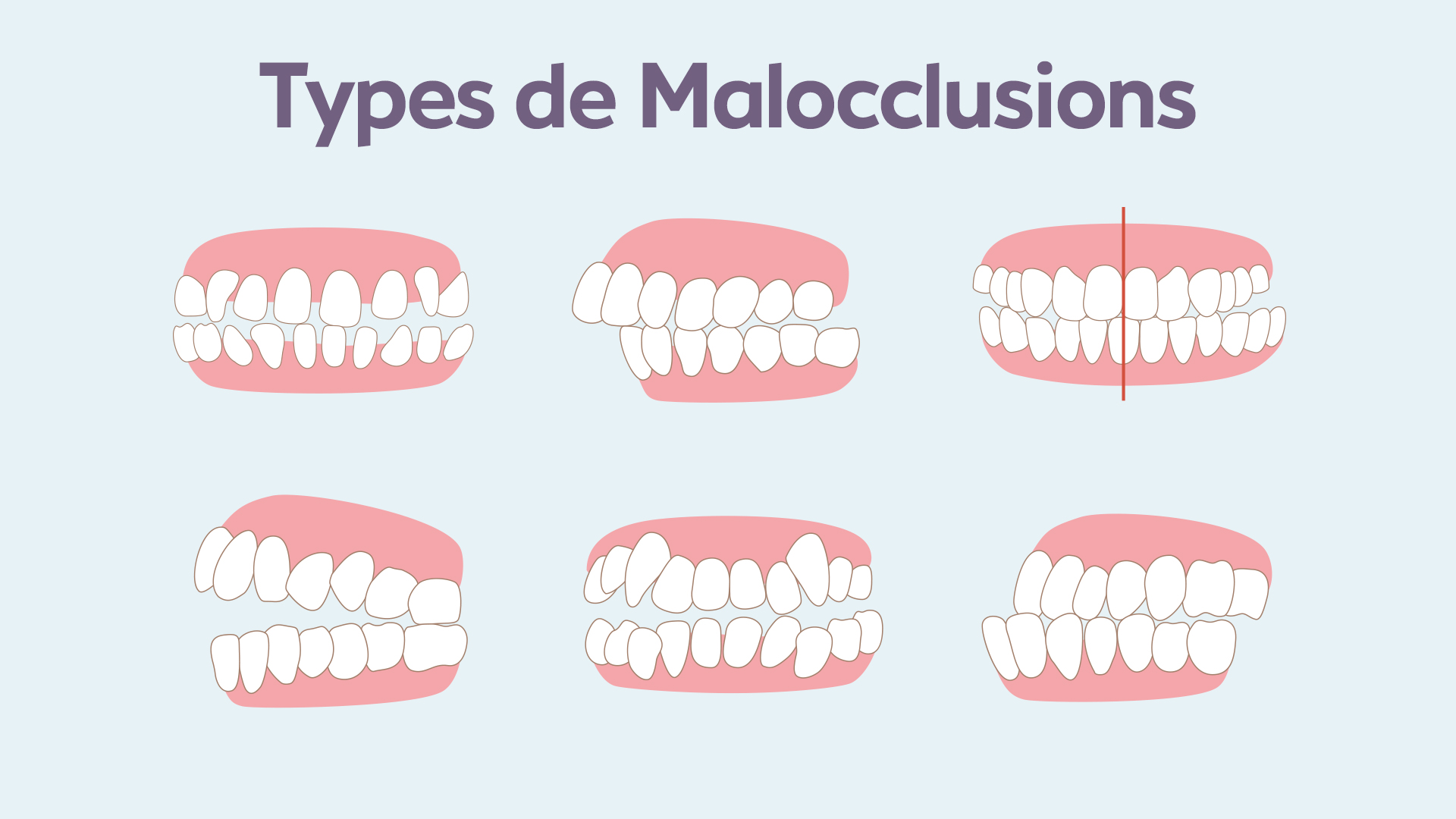 Schéma des 6 classes de malocclusion dentaire