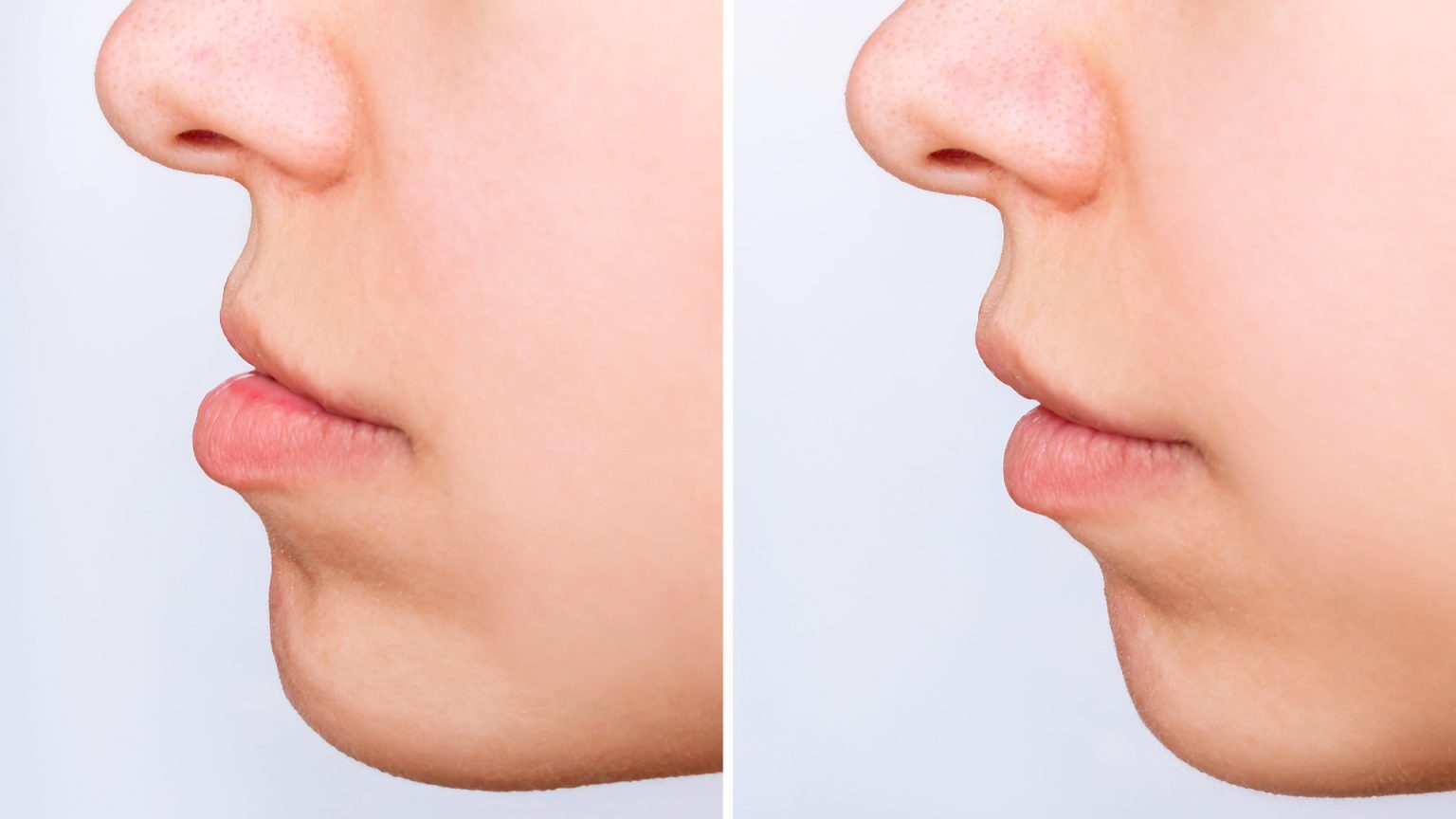 Malocclusion treatments, types and consequences