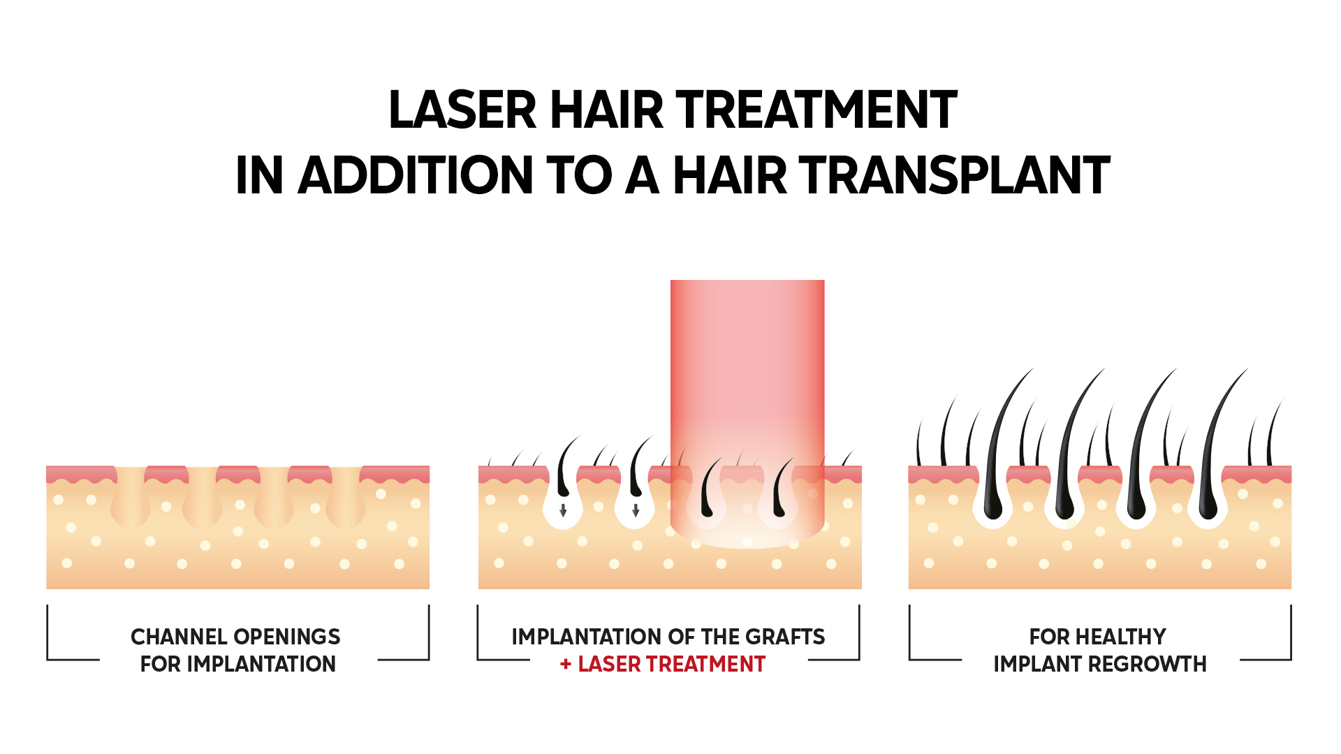 laser hair treatment in addition to a hair transplant