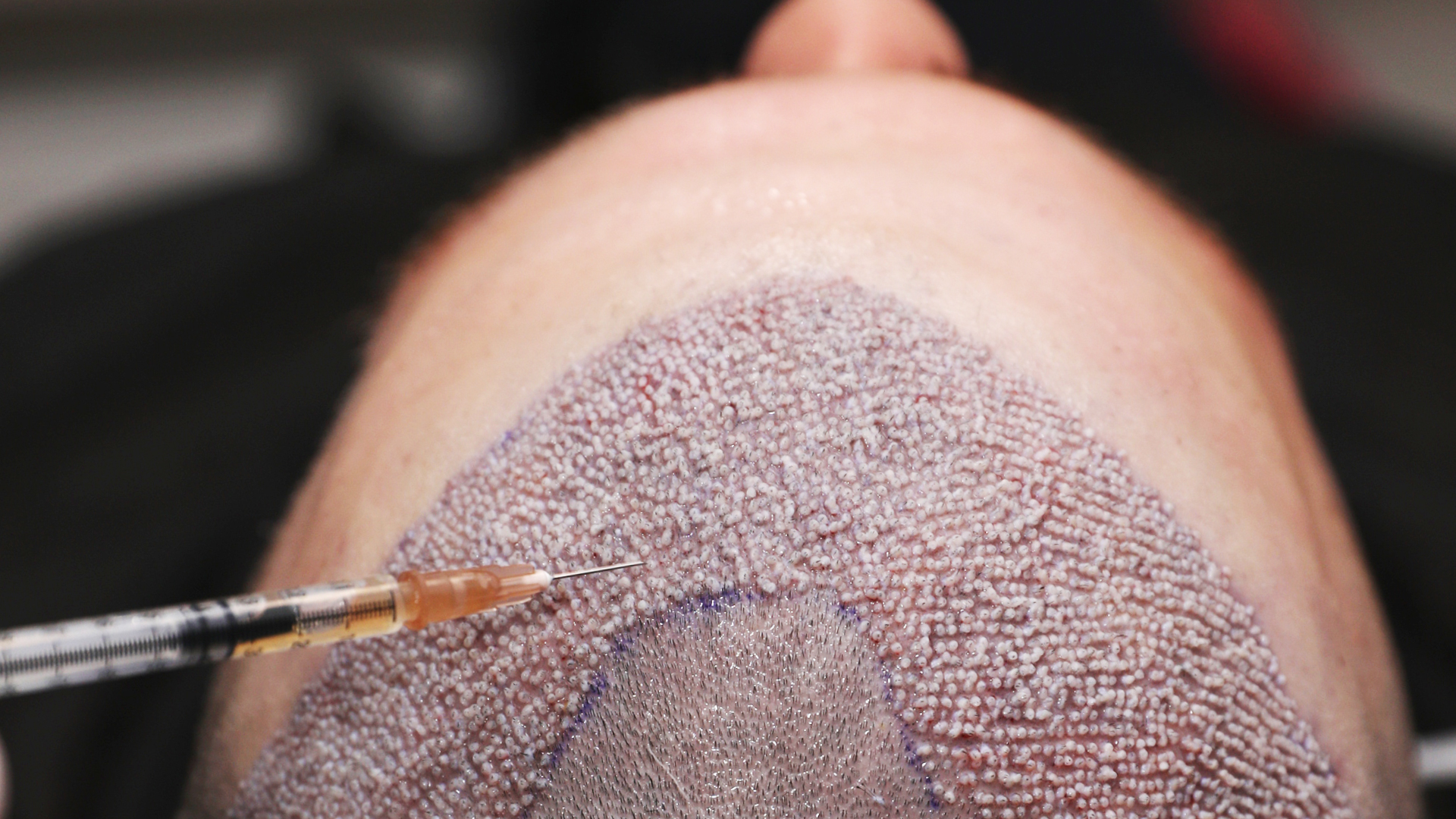 Une personne se faisant injecter du plasma dans son cuir chevelu