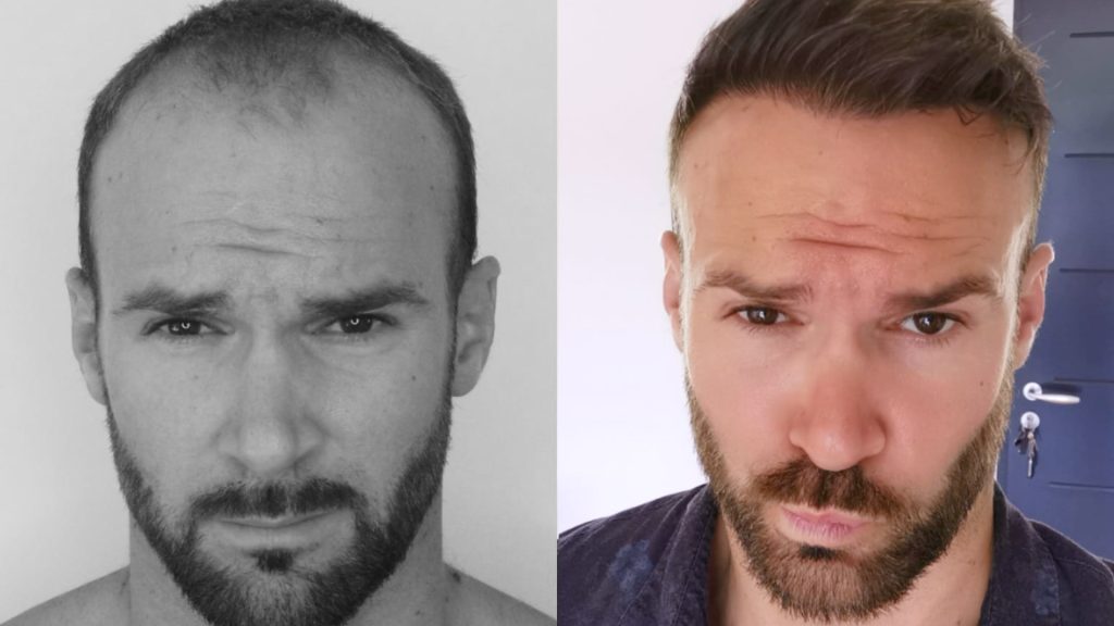 Hair transplant timeline discover the evolution month by month