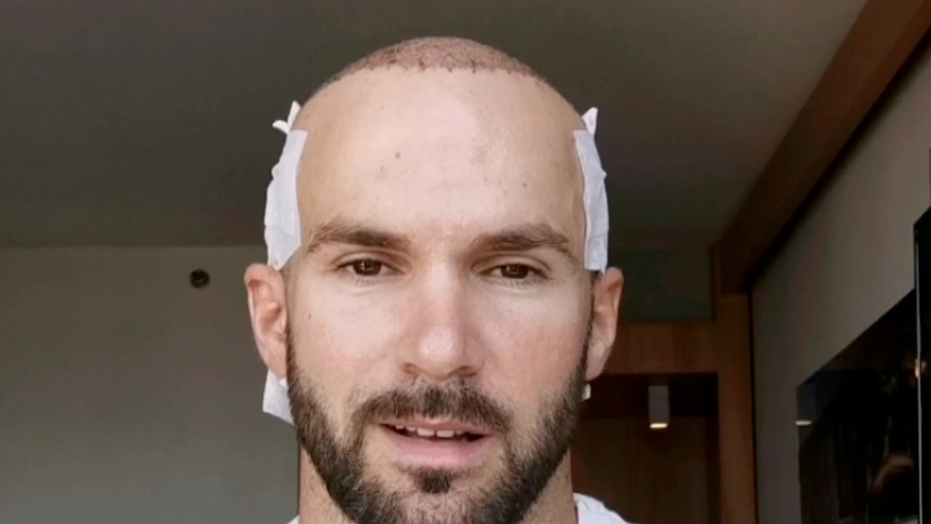 hair transplant right after the operation