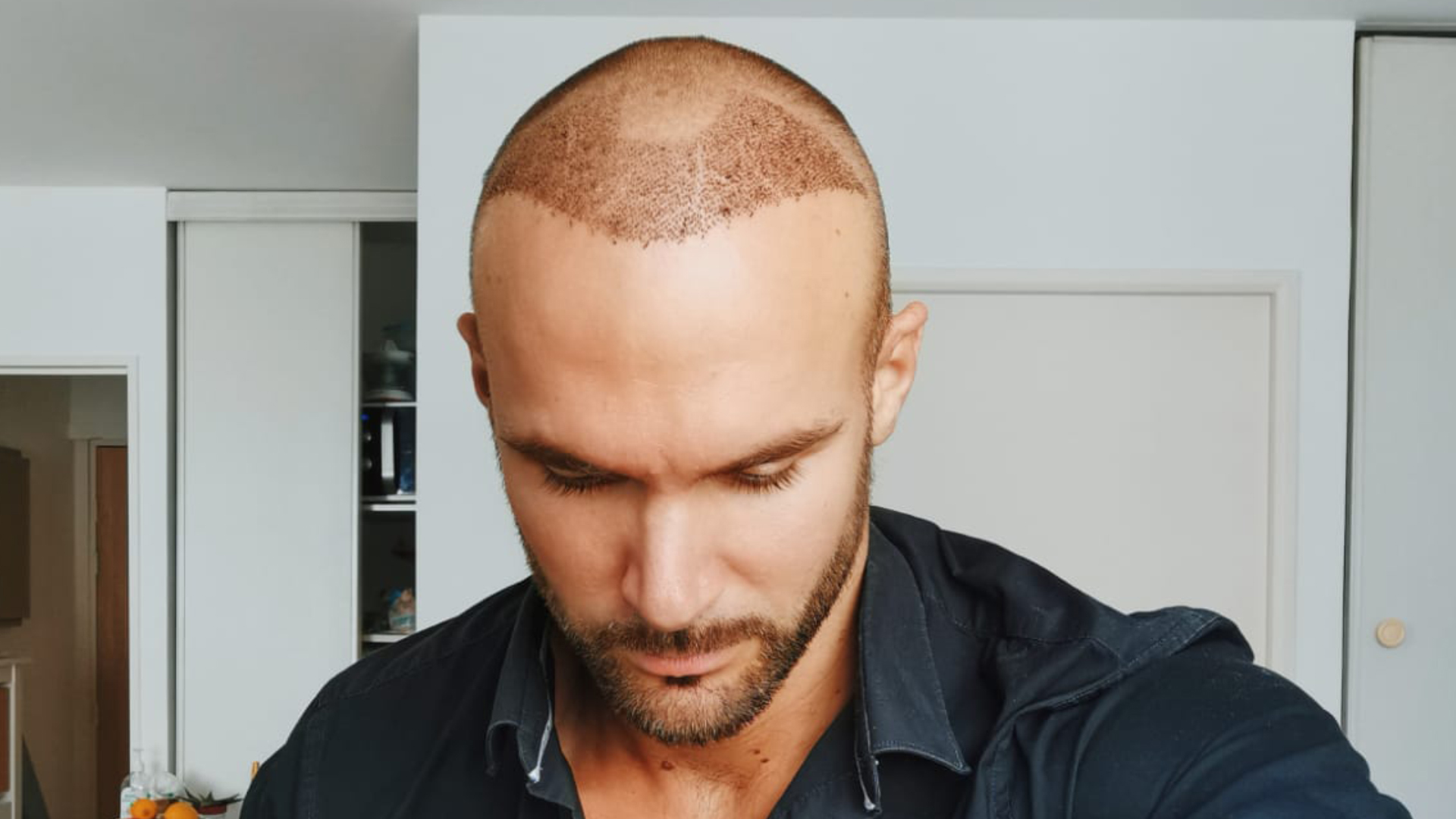 hair transplant 10 days after