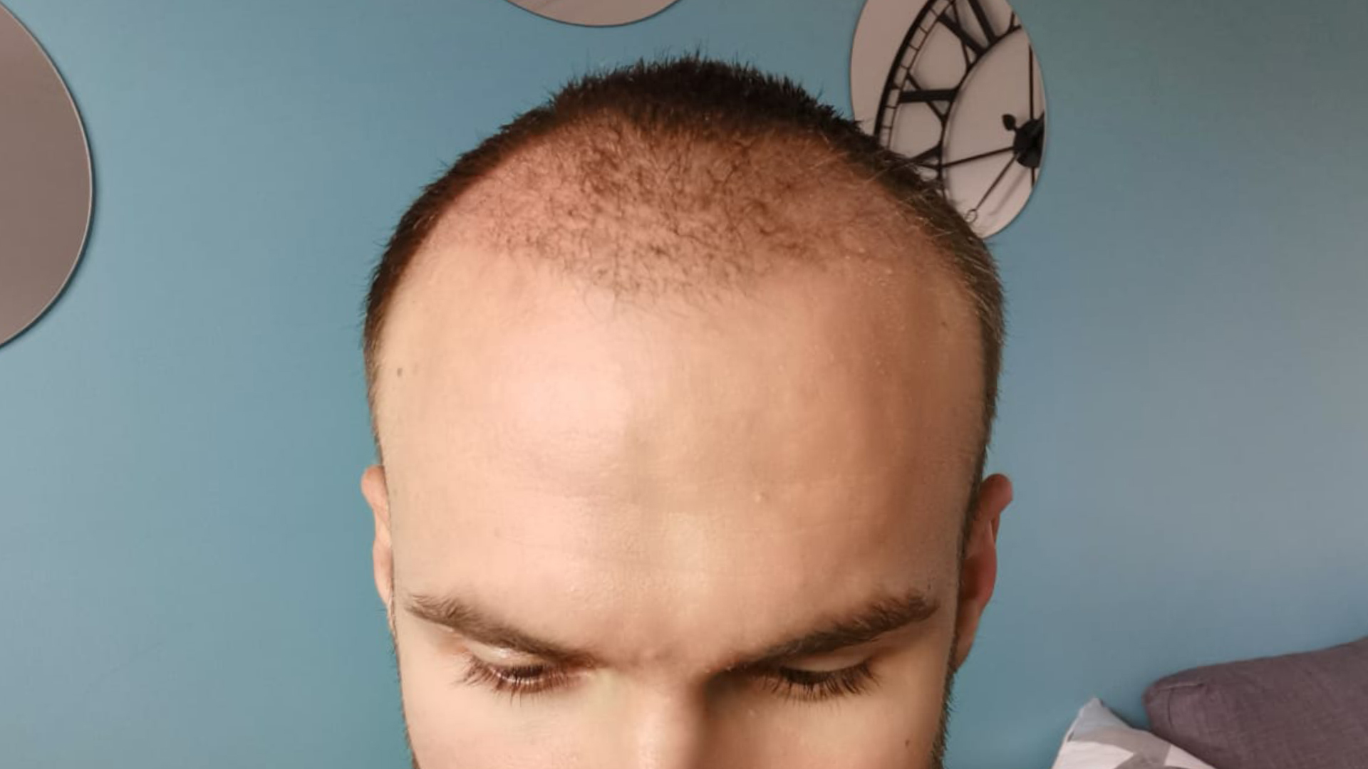 le shock loss 1 mois après une greffe de cheveux