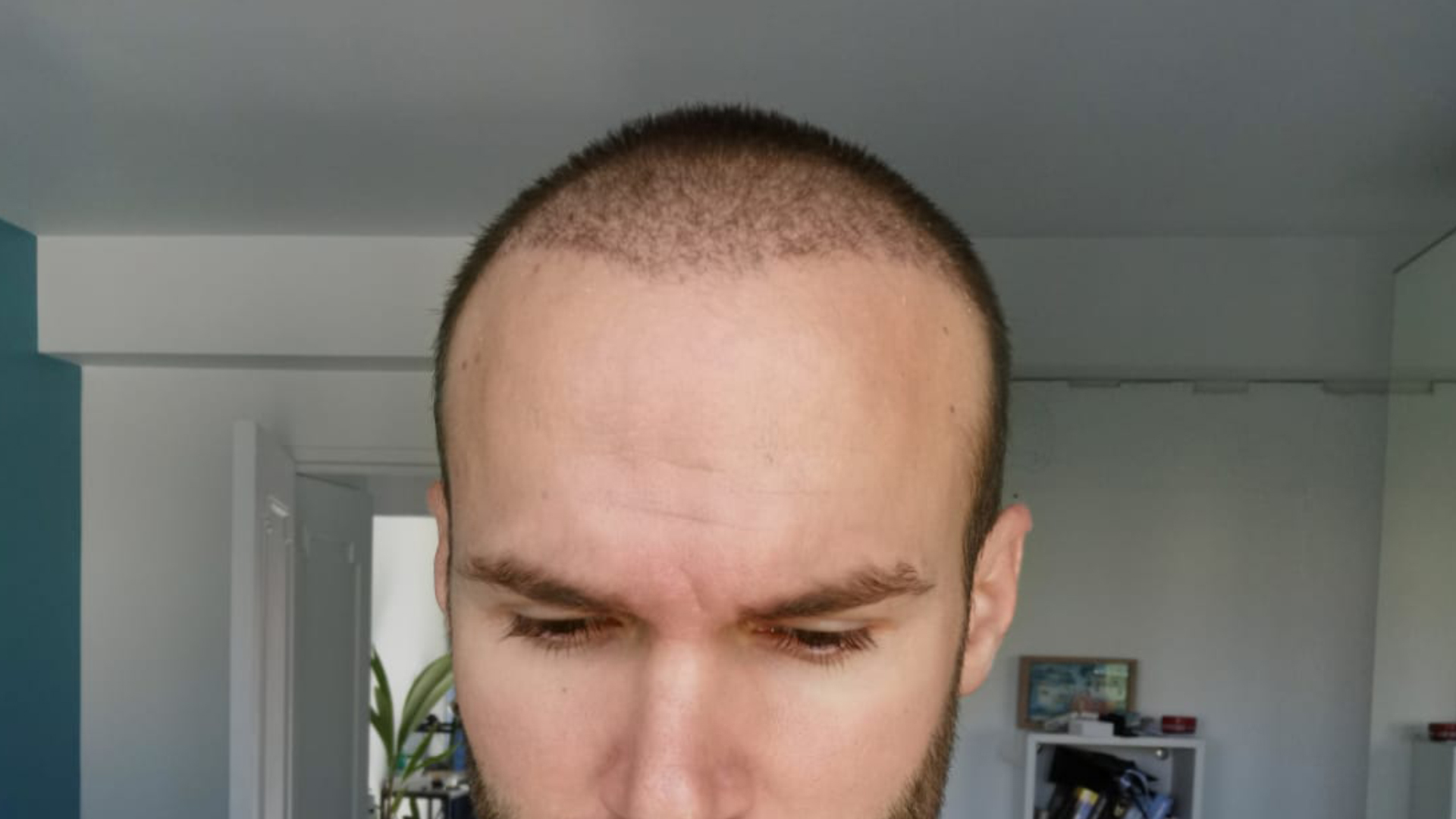 Hair Transplant Recovery Timeline  0  14 Months Photos