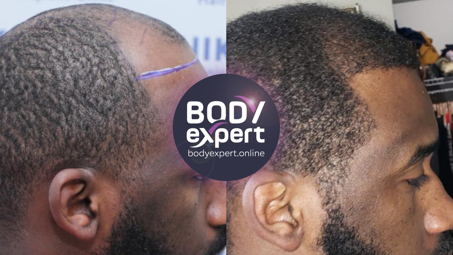 afro hair transplant in Turkey : before and after