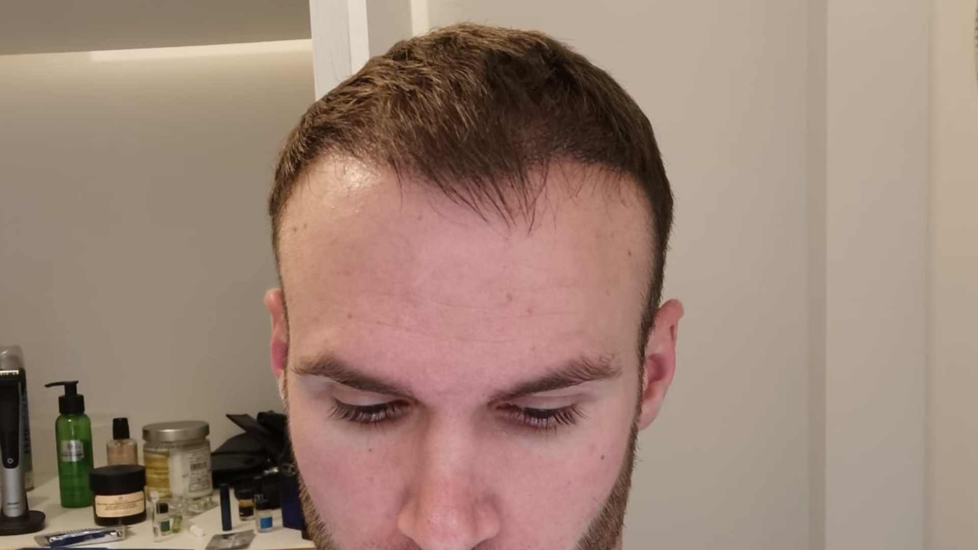 6 months after a hair transplant