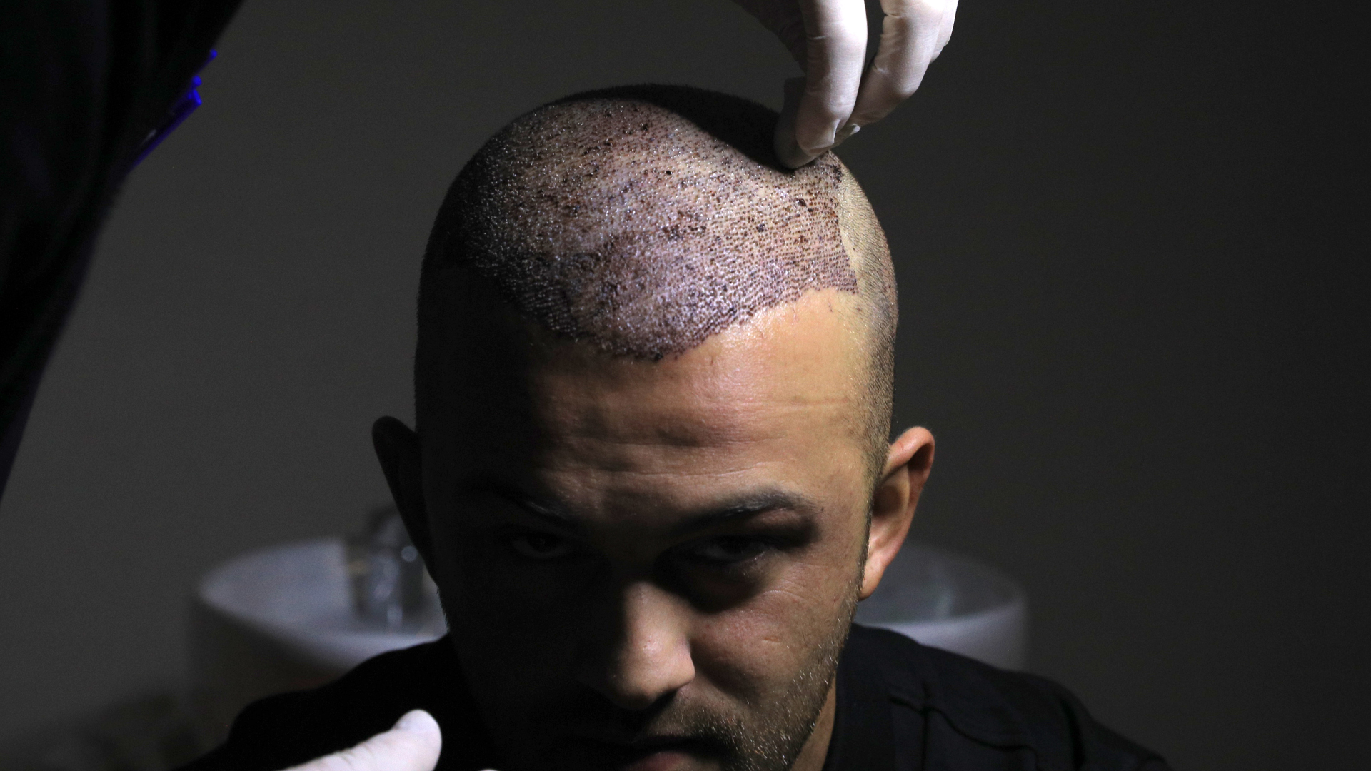 Hair transplant and scabs: everything you need to know about healing