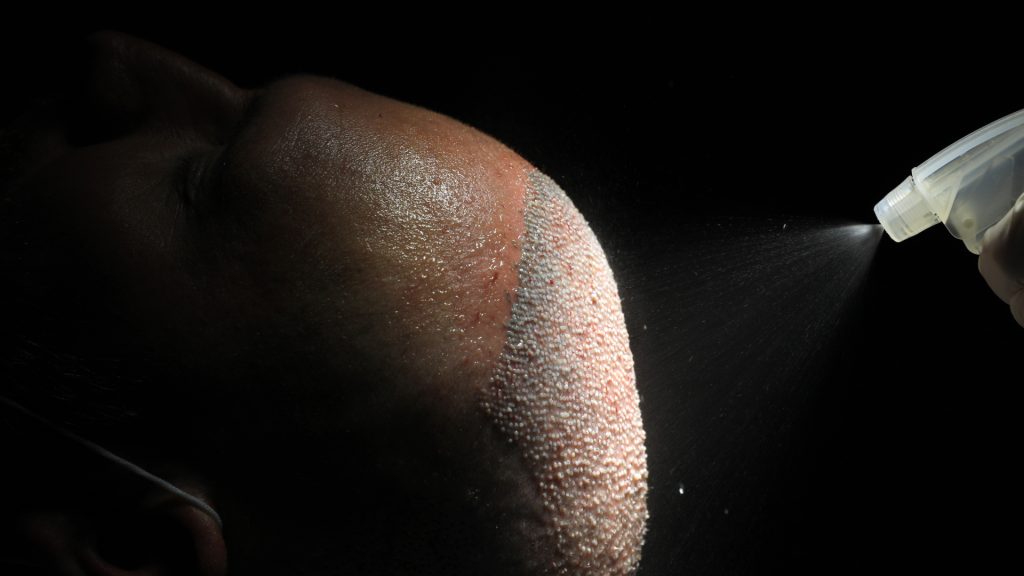 Hair transplant prices: how are they determined? Hair transplant prices: how are they determined?