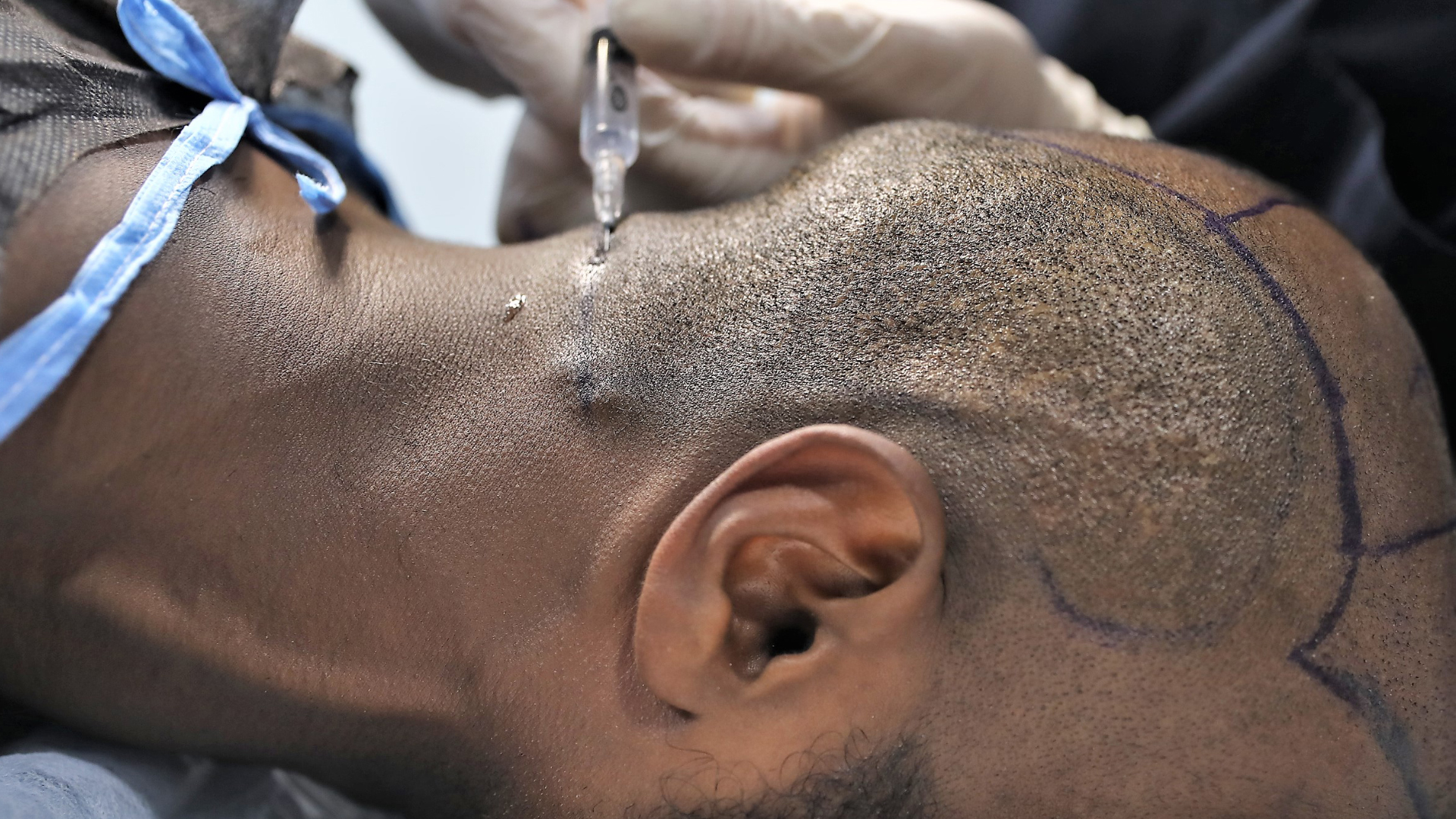 Un chirurgien spécialiste en greffe de cheveux extrait les greffons sur le crâne d'un patient